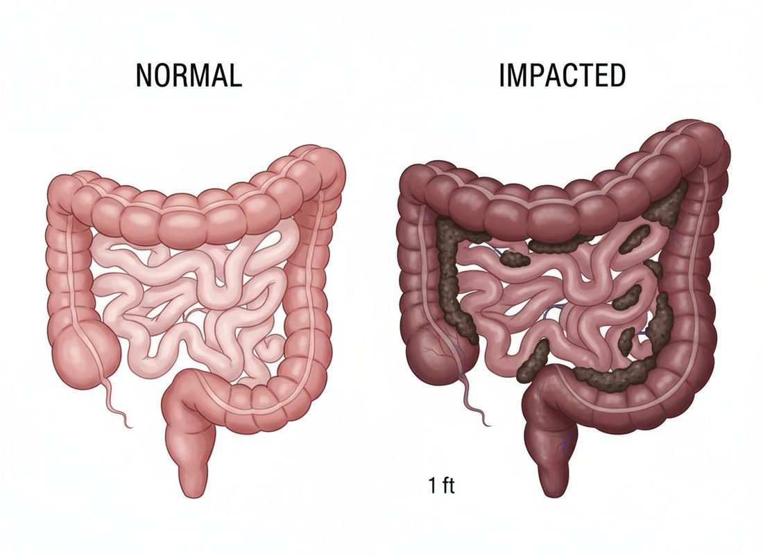 Anatomical comparison of a normal colon versus an impacted, stretched colon